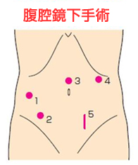 腹腔鏡下手術