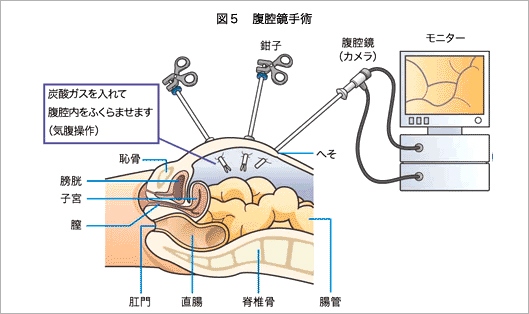 図5腹腔鏡手術 炭酸ガスを入れて腹腔内をふくらませます（気腹操作）。挿入した腹腔鏡により腹腔内の状態をモニターに映し出します。モニターを見ながら鉗子を使用して手術を行います。