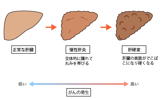 正常な肝臓から慢性肝炎へ進行すると、全体的に腫れて丸みを帯びます。さらに、慢性肝炎から肝硬変へ進行すると、肝臓の表面がでこぼこになり硬くなります。がんの発生は正常な肝臓ほど低く、慢性肝炎、肝硬変と進行するにつれて高くなります。