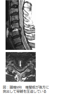 図：頚椎MRI 椎間板が後方に突出して脊髄を圧迫している