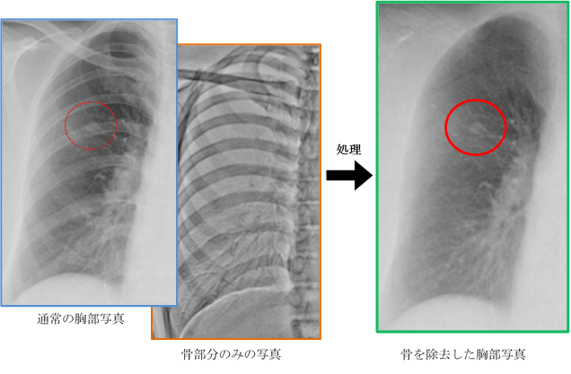 通常の胸部写真・骨部分のみの写真→骨を除去した胸部写真
