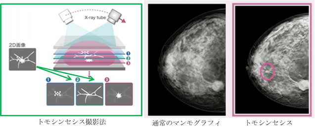 トモシンセシス撮影法　通常のマンモグラフィ　トモシンセシス